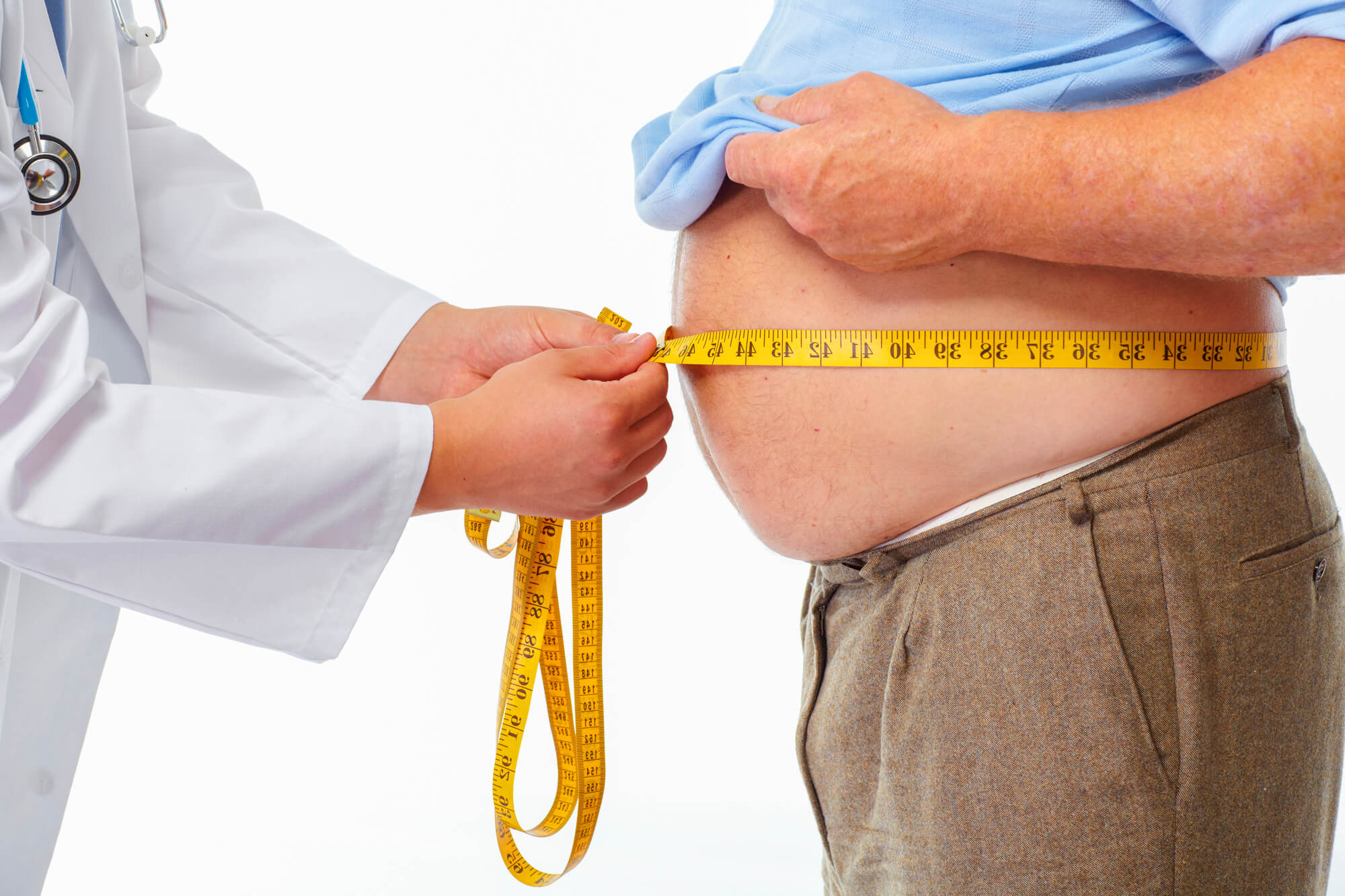 Obesidad y cálculos en los riñones